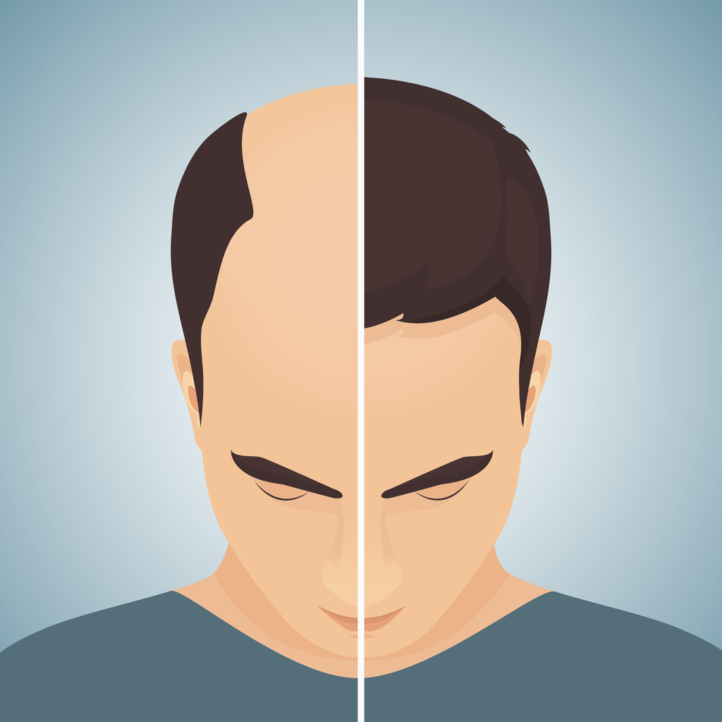 Hair loss in men - before after concept