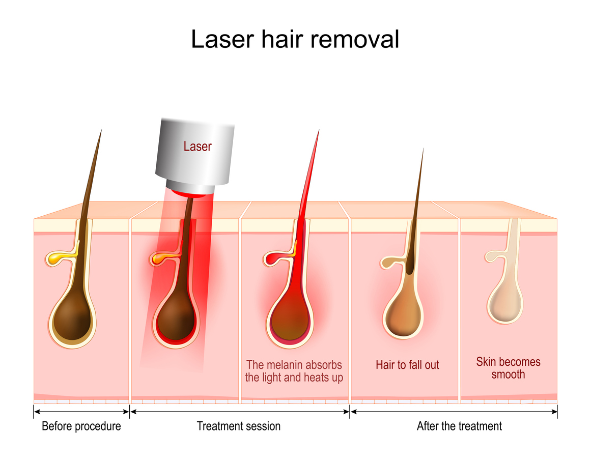 Does Laser Hair Removal Remove All Hair At Logan Lovelace Blog