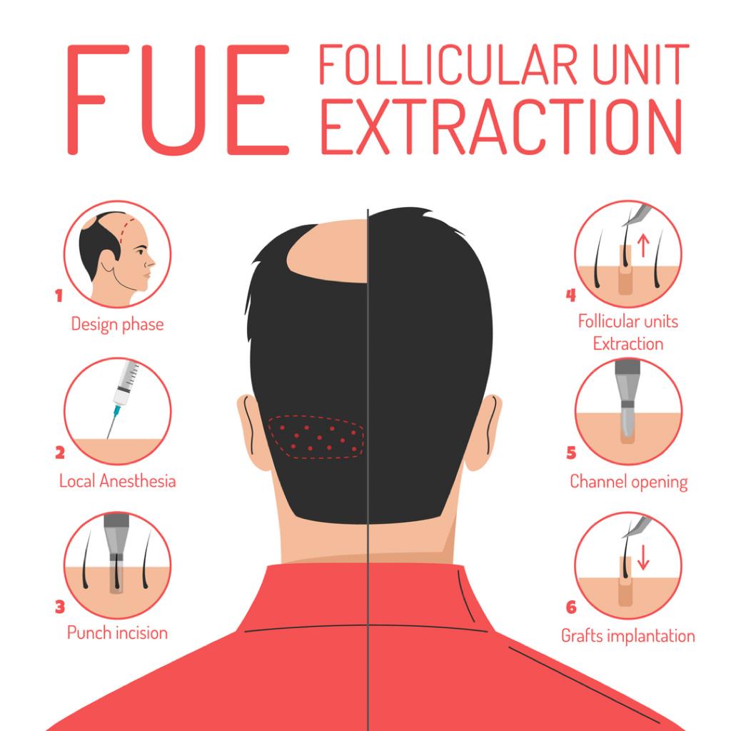 FUE hair transplant Singapore