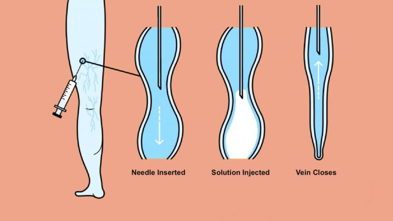 Sclerotherapy-Before-what-to-expect-during-the-procedure-1024x683