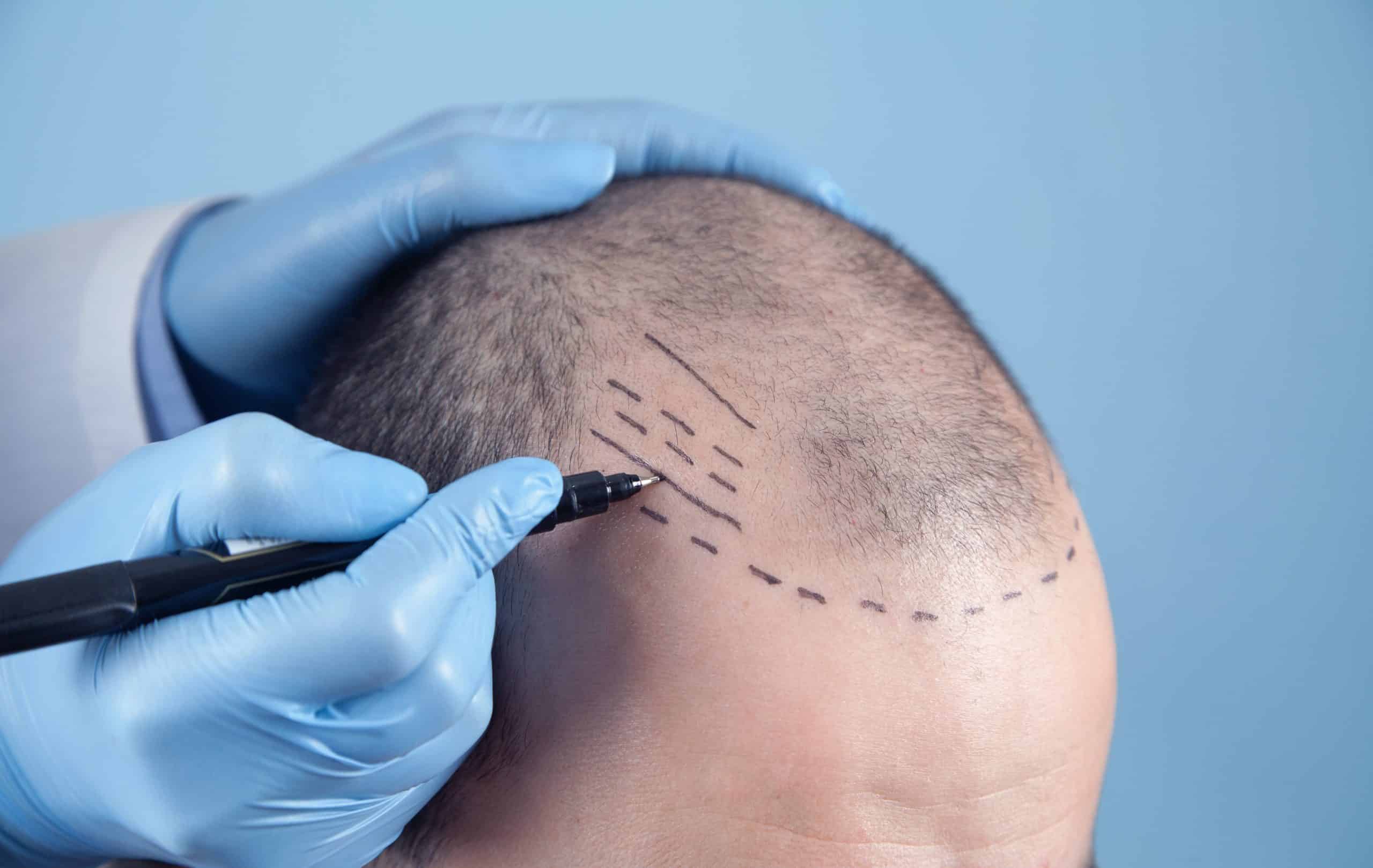 hair transplant