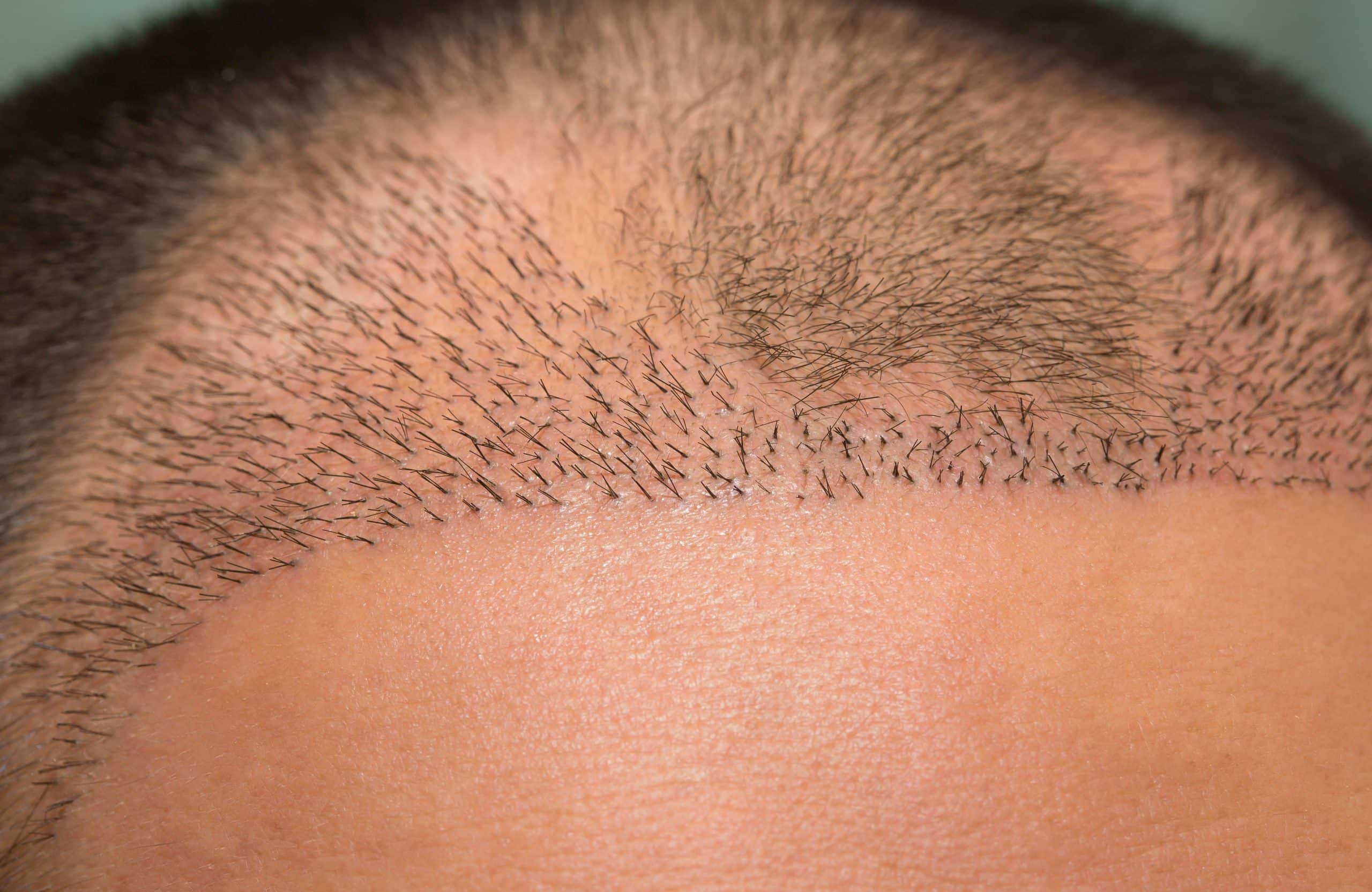 hair transplant