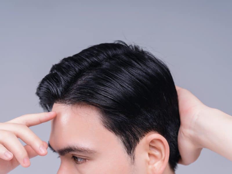 Are the results of a hair transplant permanent?