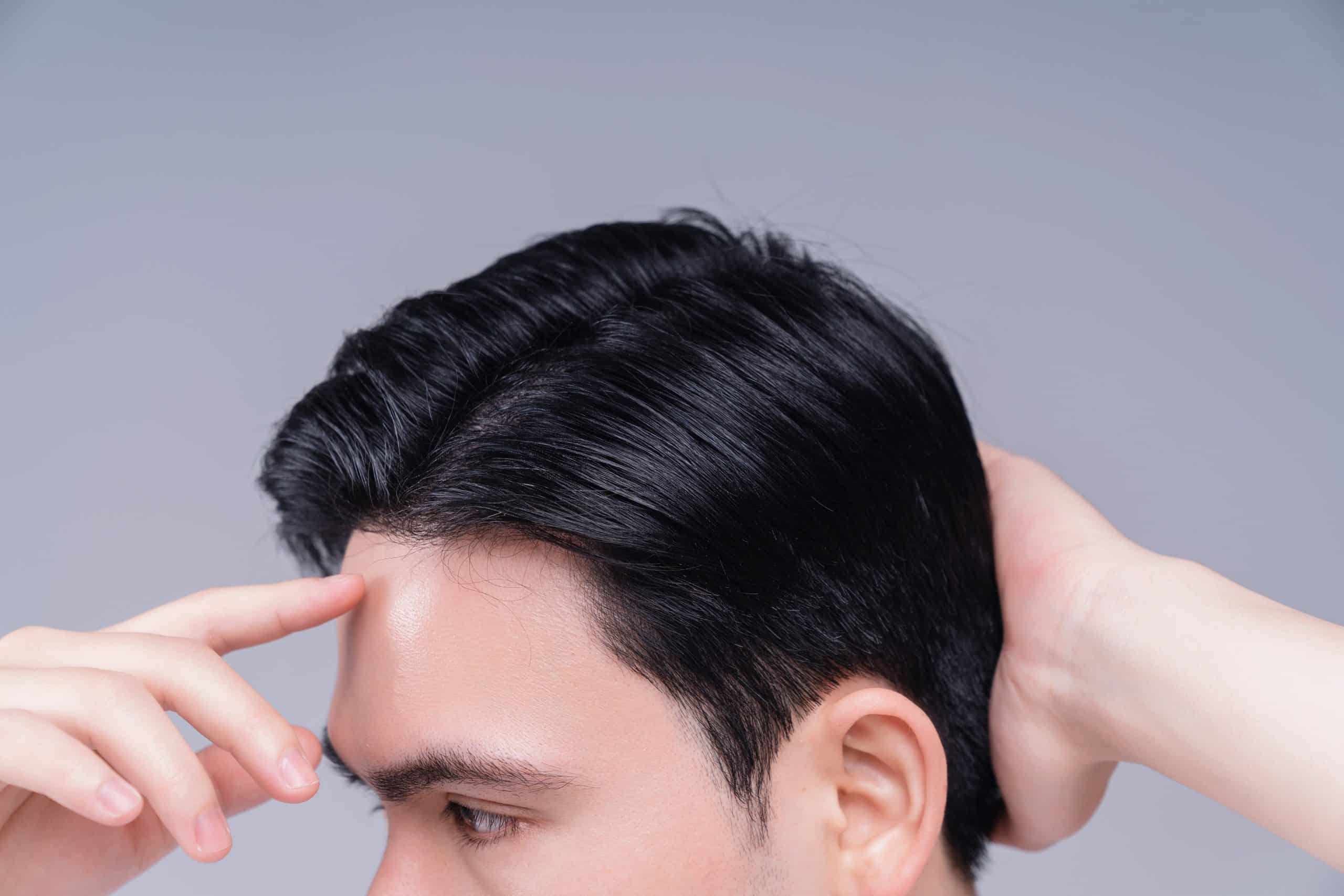 Are the results of a hair transplant permanent?