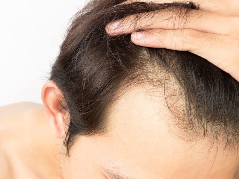 Are you and ideal candidate for FUE hair transplant