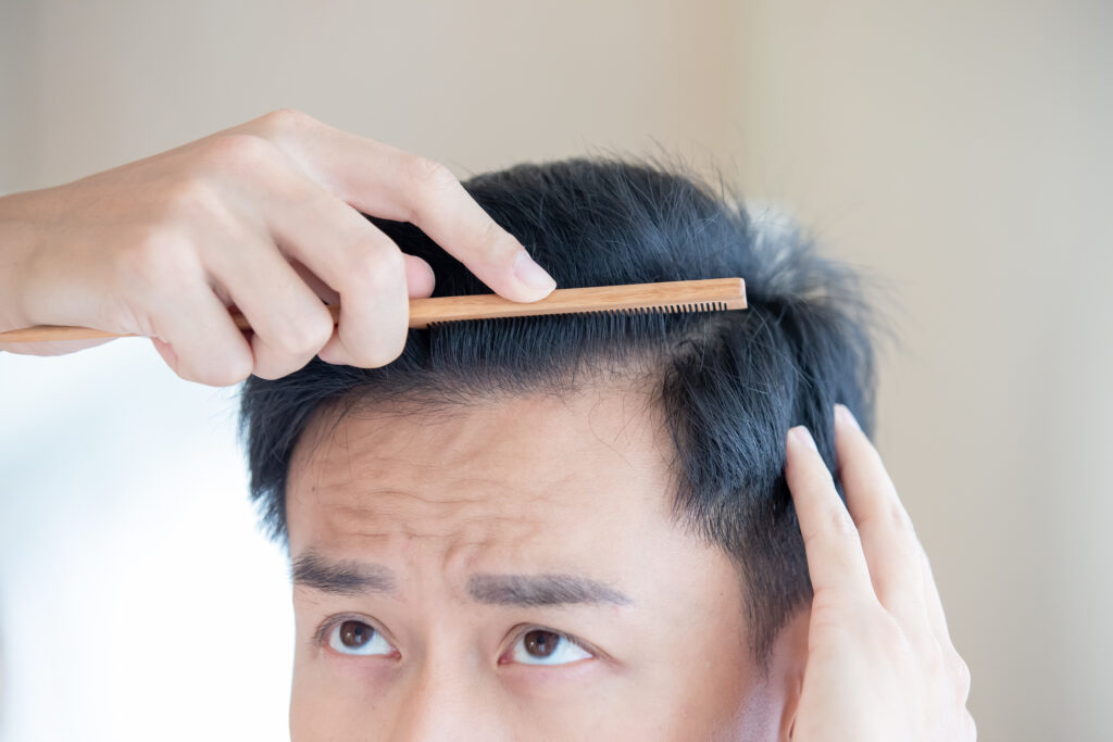 毛囊单位提取(FUE)毛发移植