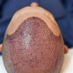 Recover to Hair Transplant