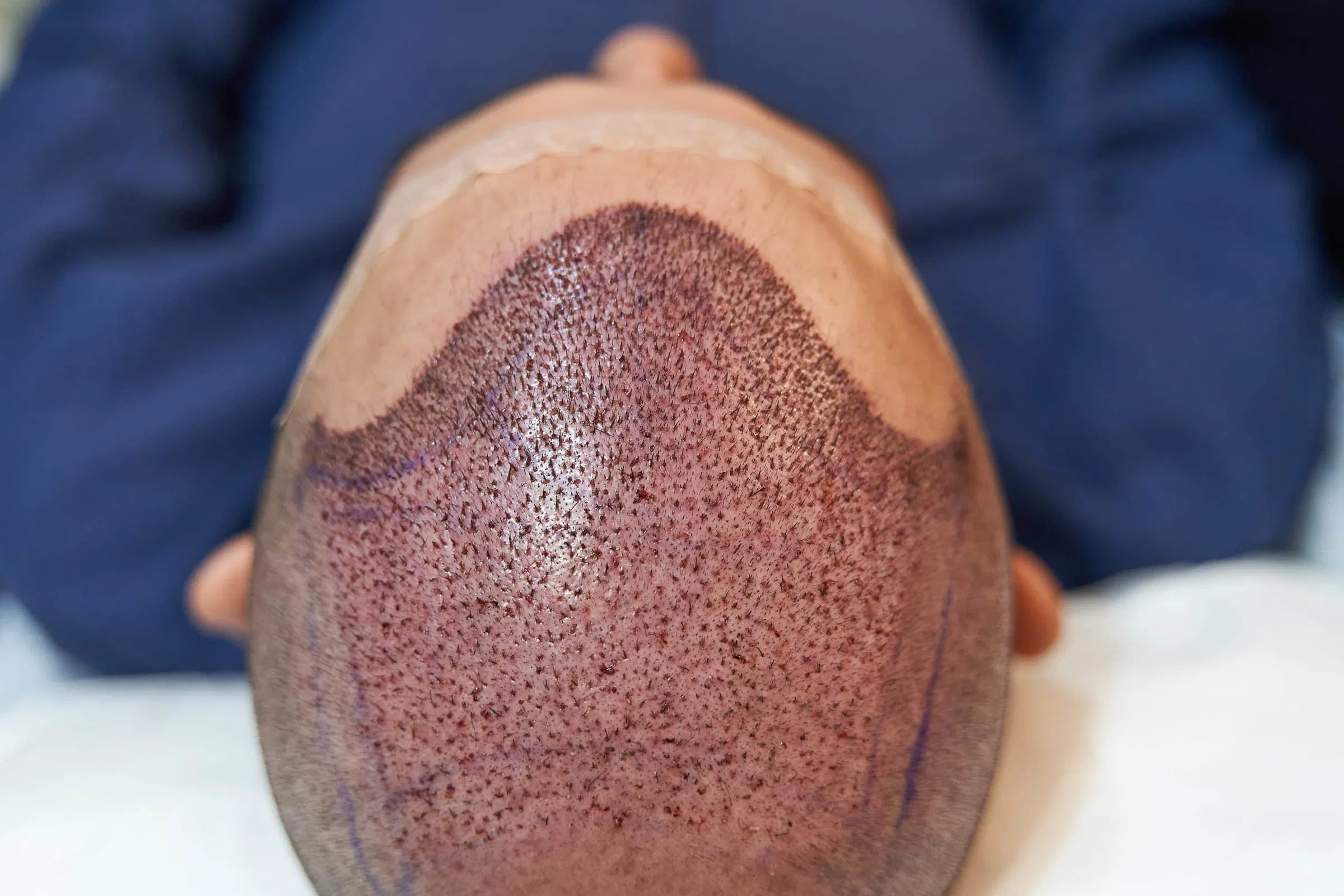 Recover to Hair Transplant