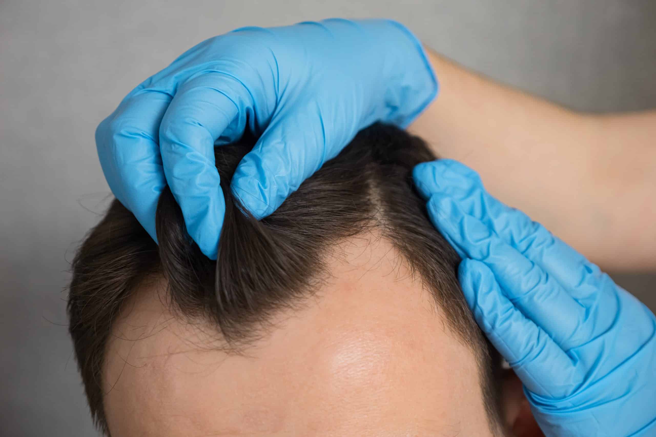 Man preparing for a hair transplant between FUE and FUT