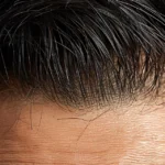 hair transplant results