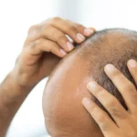 Hair Transplant