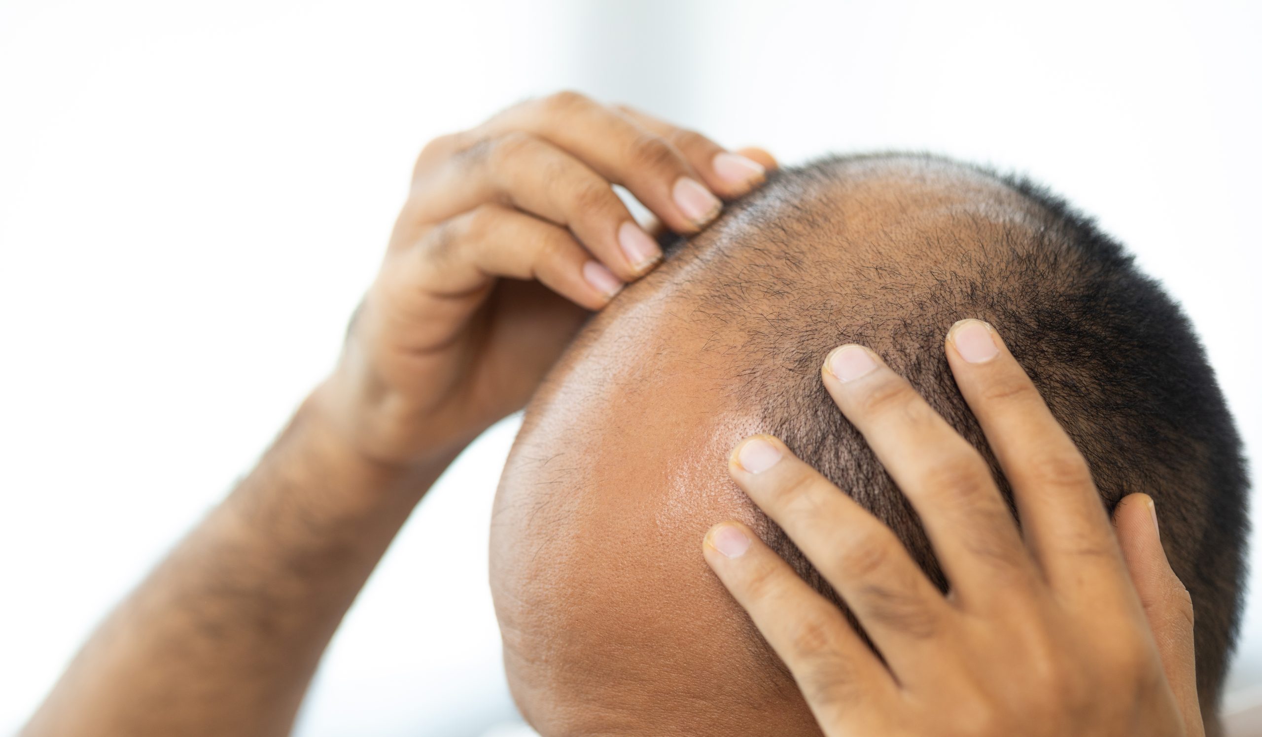 A man considering a hair transplant to restore his hairline