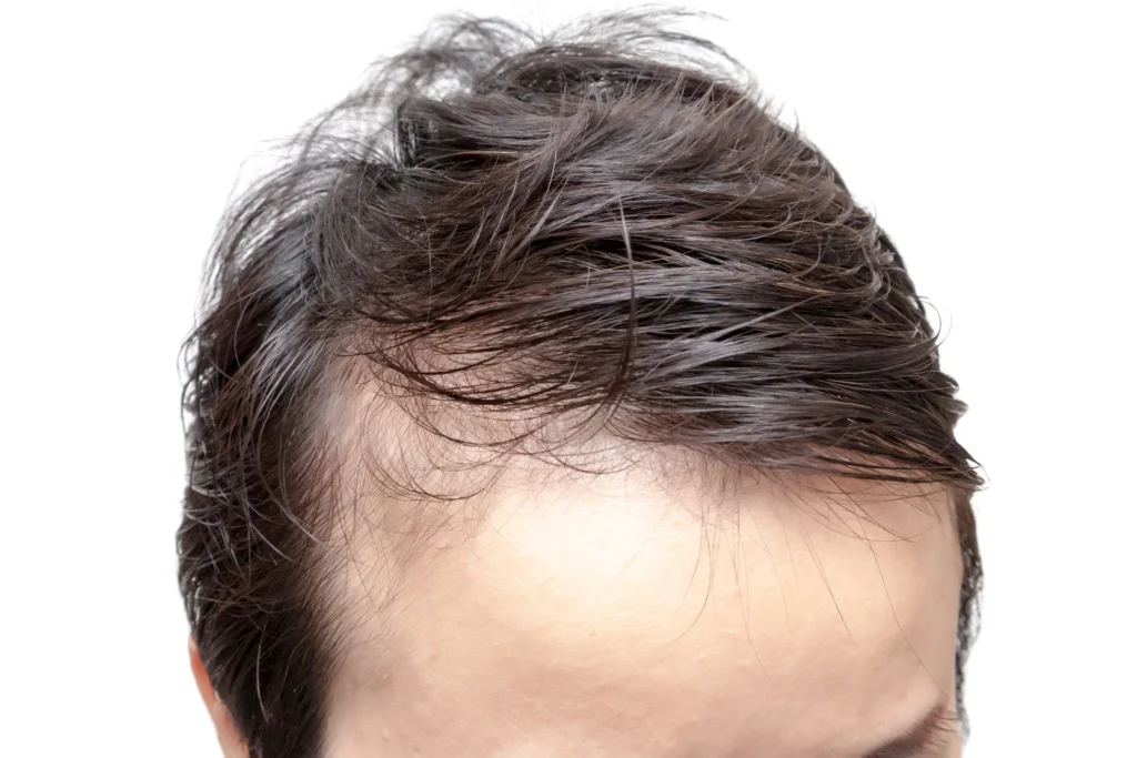 Hair Transplant