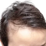Hair Transplant