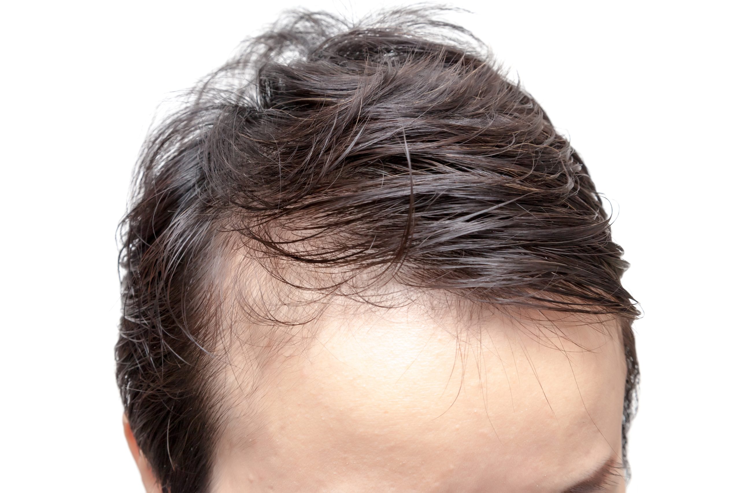A man's head before hair transplant