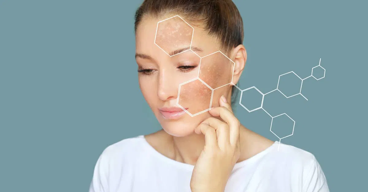 Laser Skin Pigmentation