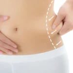 Liposuction