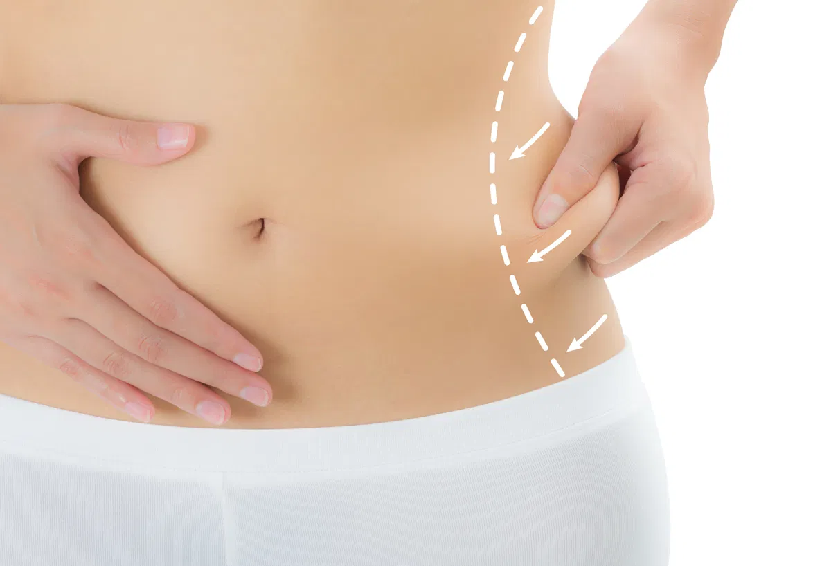 Liposuction