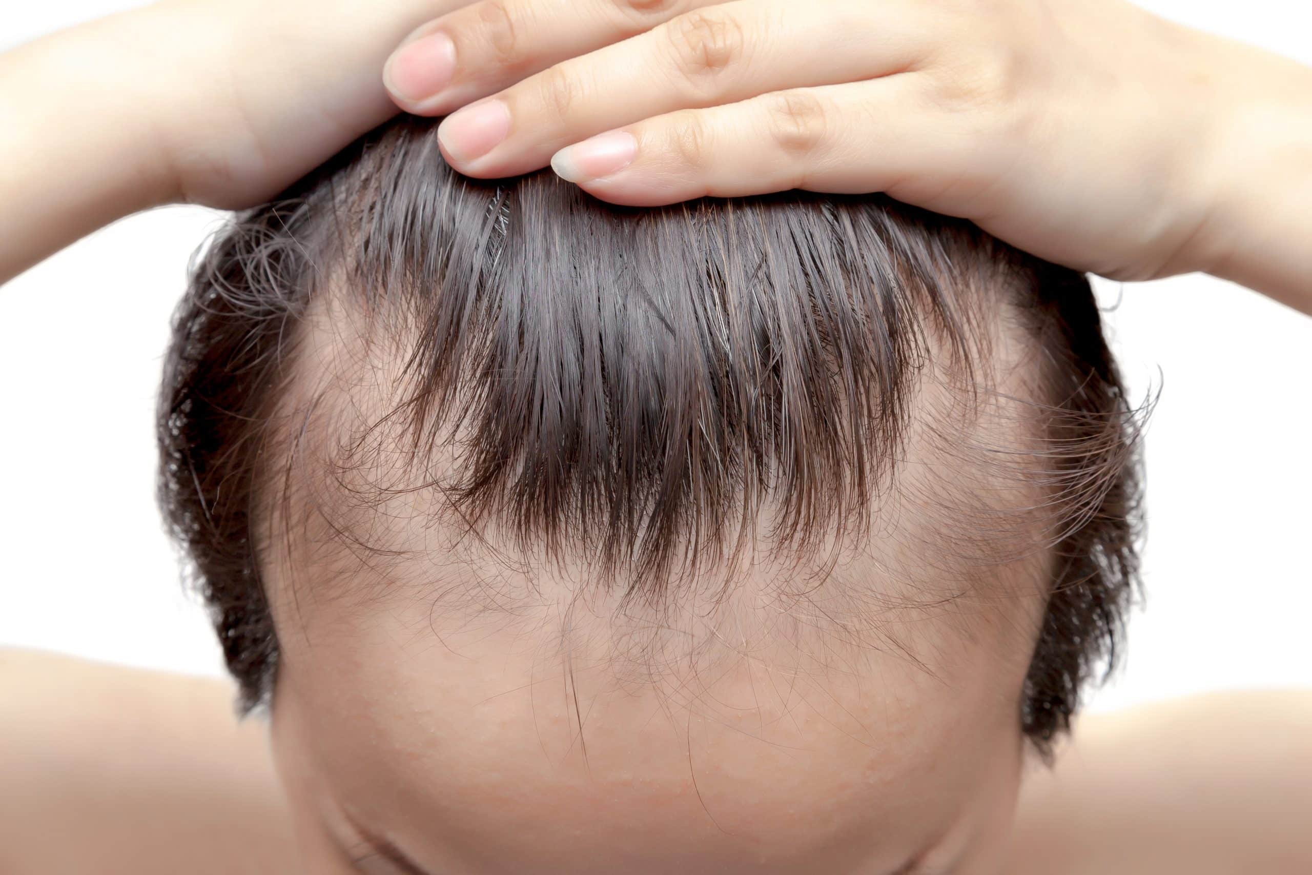Is there a right age to start hair transplant?