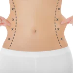 Liposuction