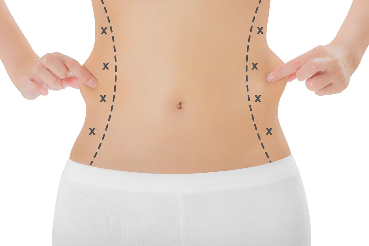 Liposuction