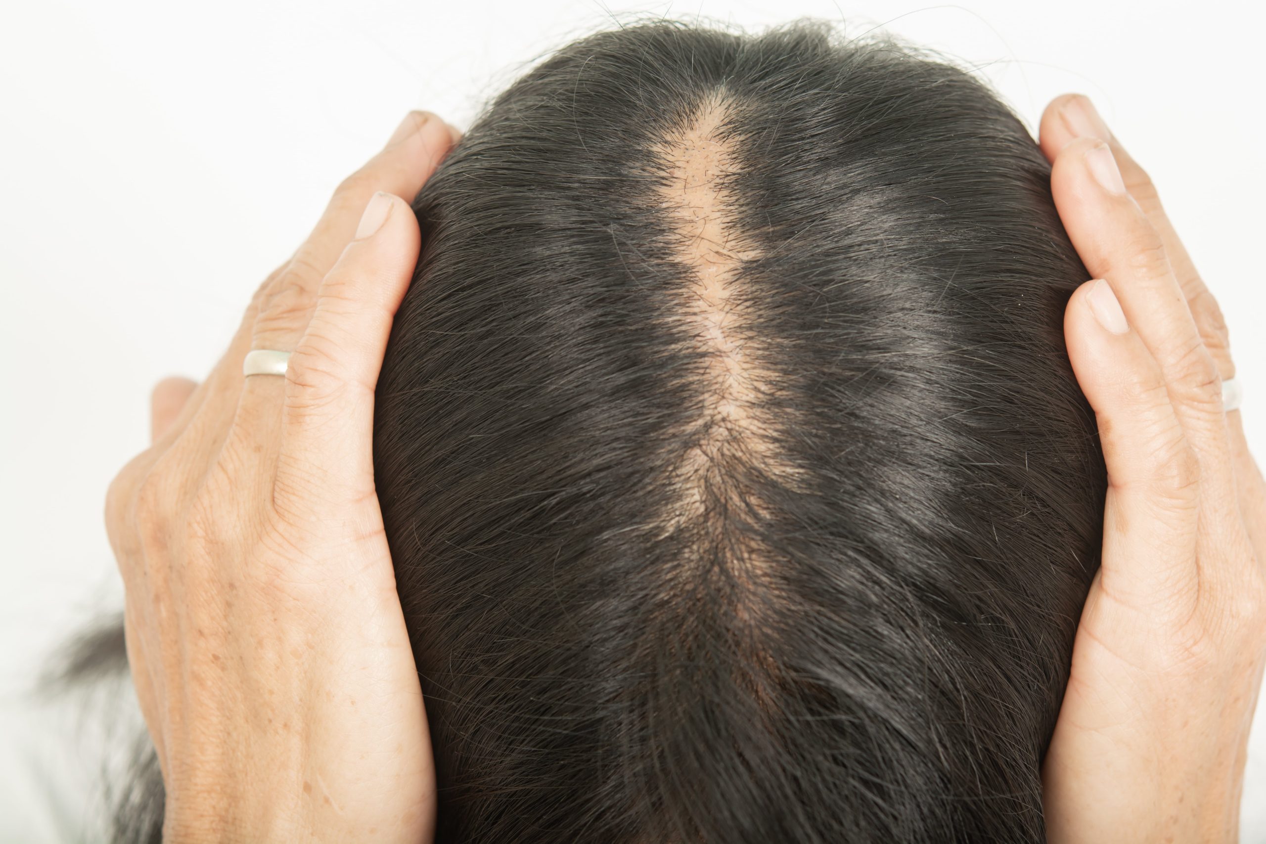 How Genetics Influences Hair Loss