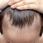 Hair Loss
